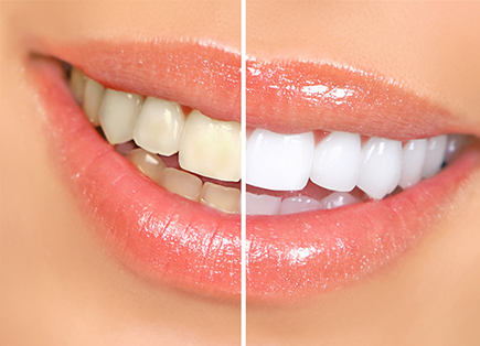 Side by side before and after pictures of teeth whitening